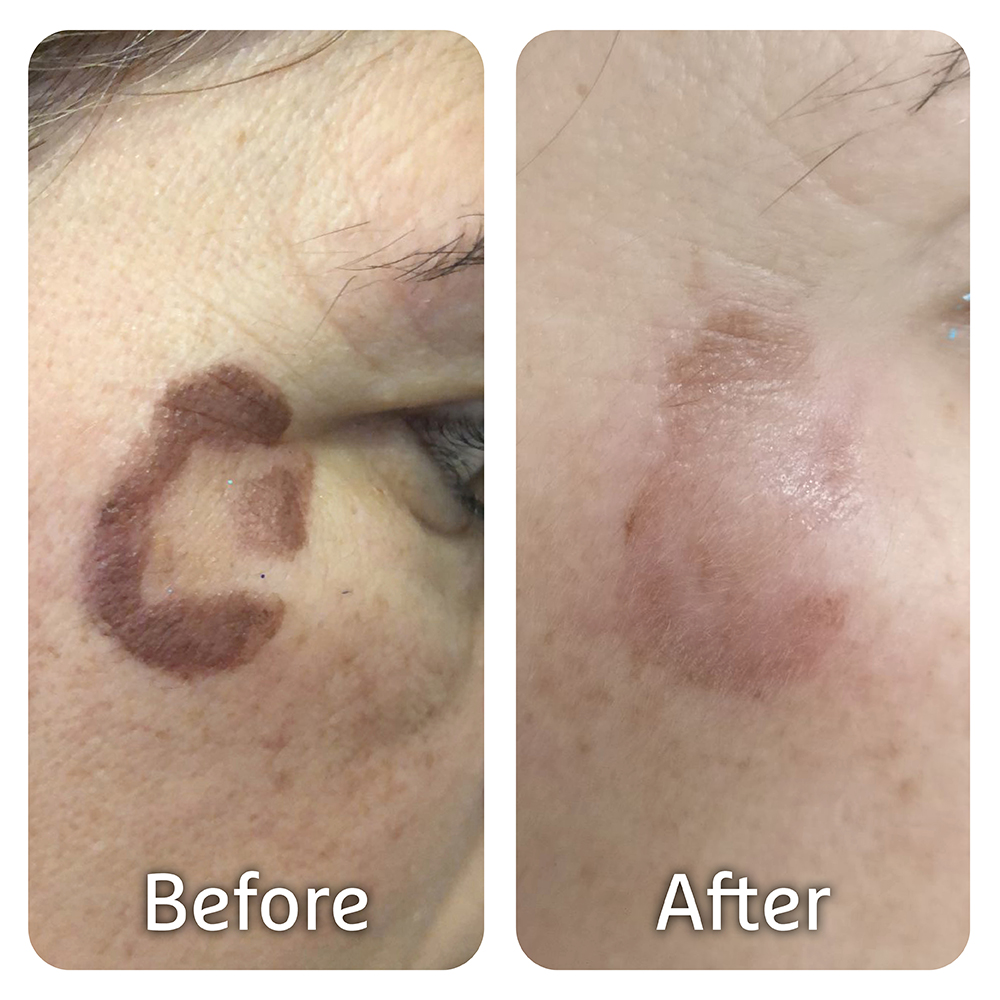 Cryotherapy Treatment - Mole Removal Maple Ridge - Royal SkinCare Clinic